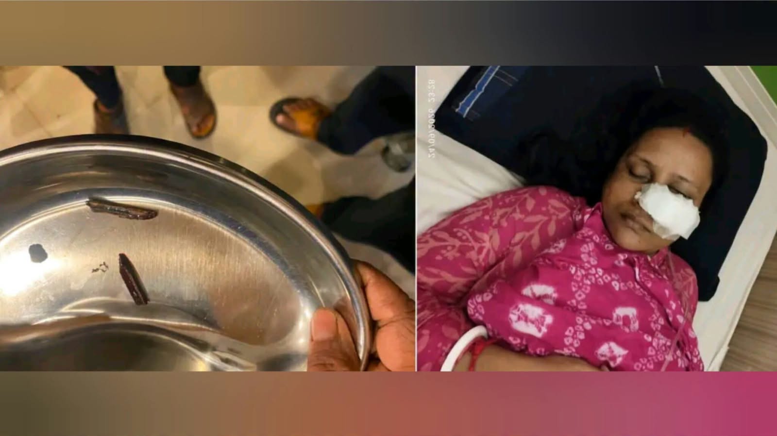 নাকের ভেতরে অপারেশনে মিললো বাঁশের দুটি টুকরো